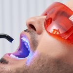 izbjeljivanje zubi, profesionalno izbjeljivanje zubi u tuzli