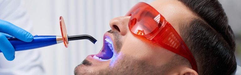 izbjeljivanje zubi, profesionalno izbjeljivanje zubi u tuzli