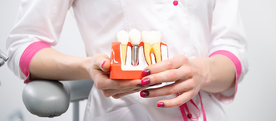 dentalni implantati tuzla, najbolje rješenje ako vam nedostaje jedan ili više zuba