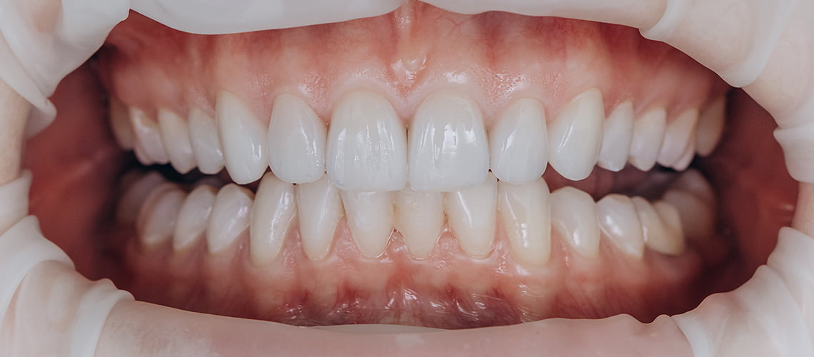 izbjeljivanje zubi, bijeli i blistavi zubi