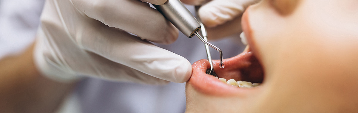 Endodoncija Tuzla, uspješno izliječite kvarni zub