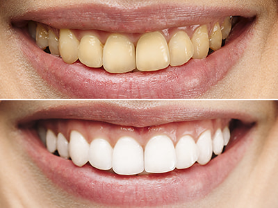 izbjeljivanje zubi tuzla, prije i poslije izbjeljivanja