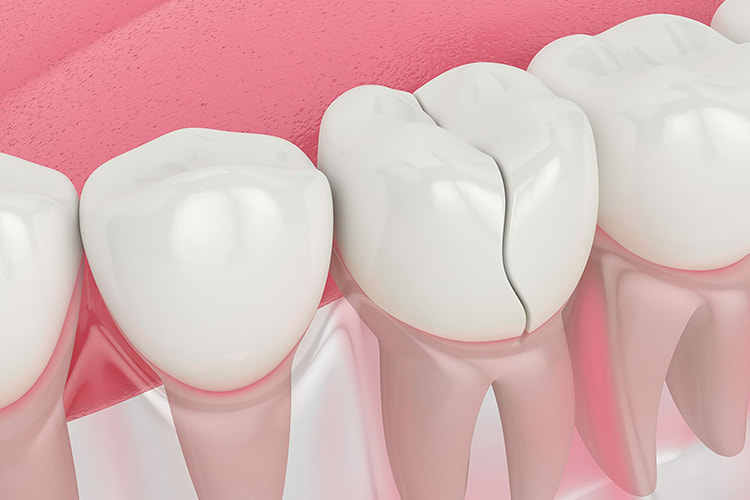 estetska stomatologija tuzla, slomljen zub