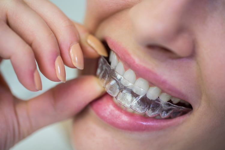 ortodoncija tuzla, aparatić za zube, izgled zuba sa aparatićem