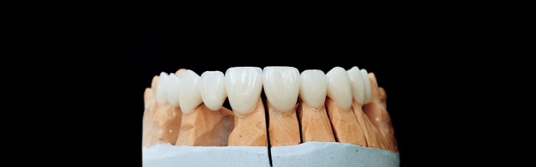 Zubna protetika, zubne krunice, zubni mostovi, zubni implantati, Novodent stomatološko implantološki centar Tuzla