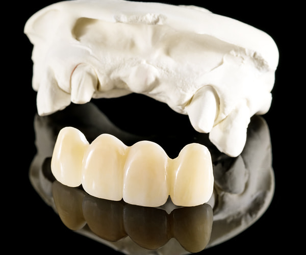 zubna protetika novodent tuzla, zubni most